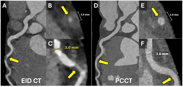Computed Tomography and Coronary Plaque Analysis.