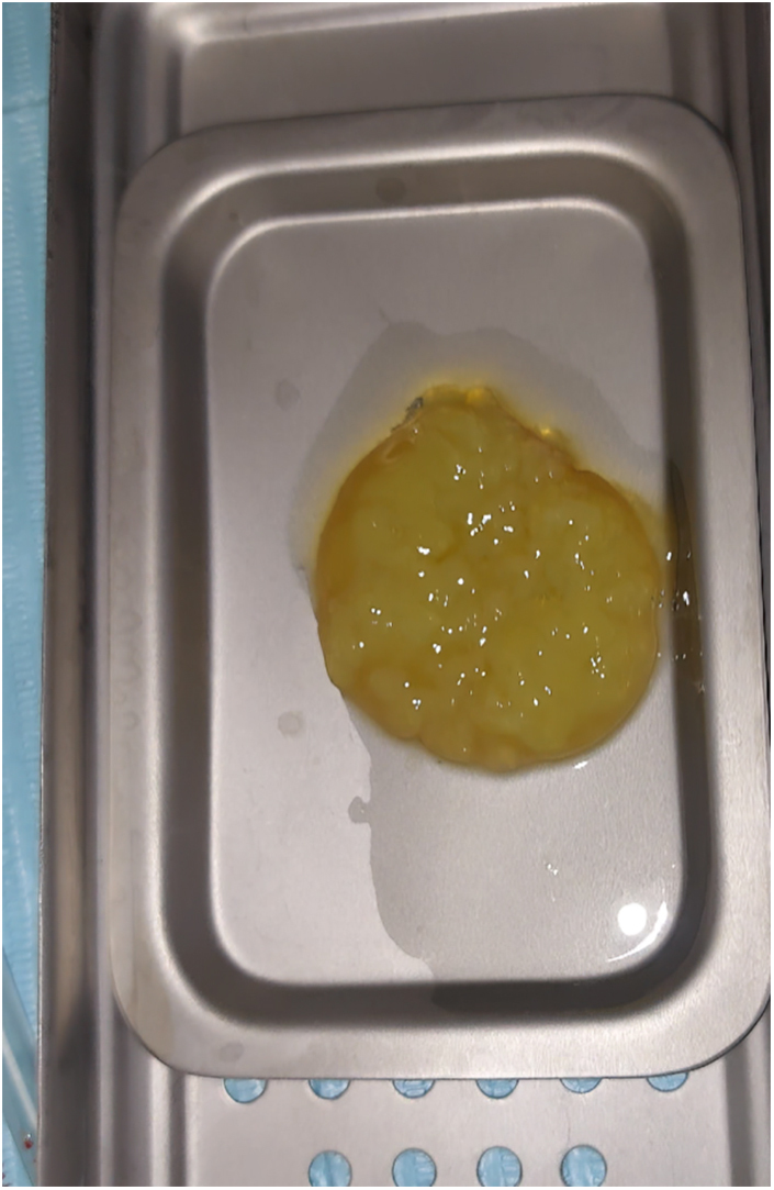 Efficacy of platelet-rich albumin and fibrin gel in two-stage lateral sinus lift: a prospective study.