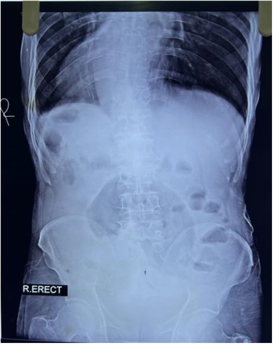 A case of situs inversus totalis with sigmoid volvulus: a case report of a rare coexistence.