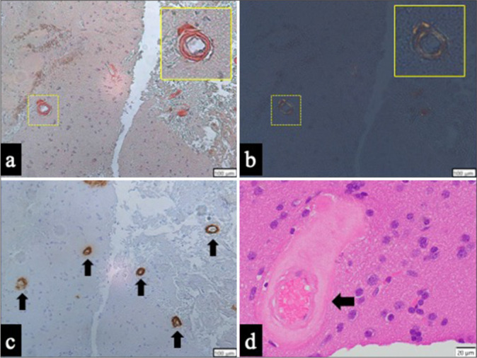 Probable cerebral amyloid angiopathy-related inflammation presenting with dissociated hemorrhagic and inflammatory lesions in a middle-aged patient: A case report.