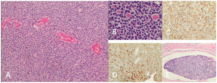 Late retroperitoneal recurrence of adult-type ovarian granulosa cell tumors: Two case reports and literature review.