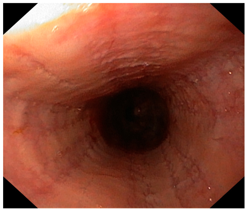 Eosinophilic Esophagitis in a 3-Year-Old Girl with Spinal Muscular Atrophy Type 1: The First Reported Case.