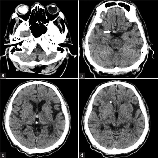 Intraventricular and subarachnoid migration of silicone oil from previous intraocular injection mimicking intracranial haemorrhage: a case report.