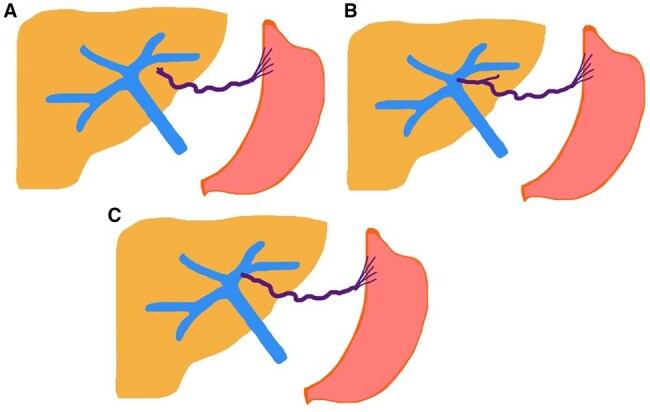 CT imaging of third inflow cases: a hidden cause of surgical complications and liver pseudolesions.