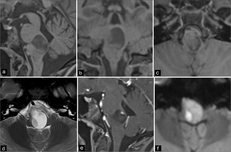 Intrinsic brainstem epidermoid cyst in childhood.