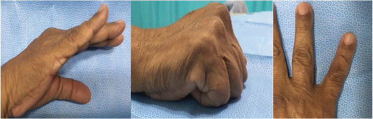 Hamartoma of the Finger: A Case Report.