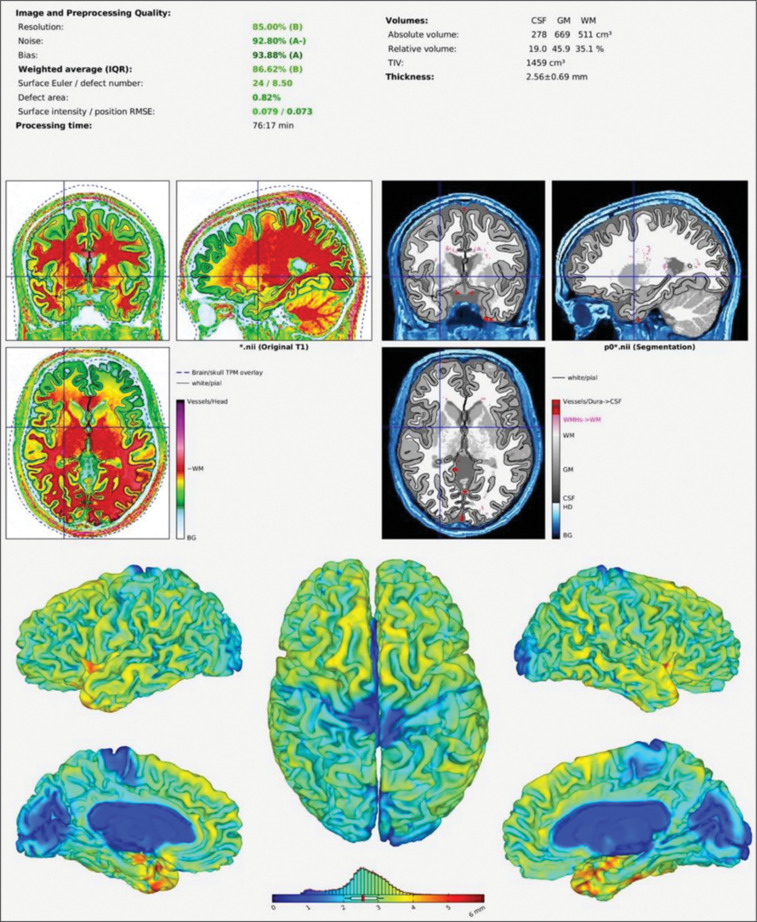 Comparison of structural brain volume among sedentary normal, overweight and obese adults - A cross-sectional study.