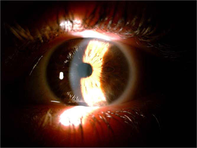 Cyclosporine eye drops in lattice corneal dystrophy type 1: case report.