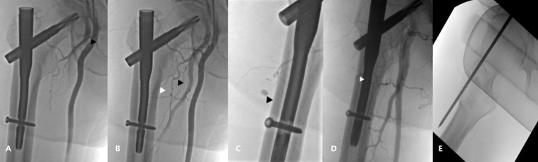 Iatrogenic injury to the descending branch of the lateral circumflex femoral artery during intertrochanteric fracture fixation: a case report of guide pin-related vascular complication.