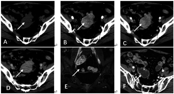 Late retroperitoneal recurrence of adult-type ovarian granulosa cell tumors: Two case reports and literature review.