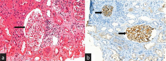 Post Transplant Membranous Nephropathy: A 10-year Single-Centre Experience.