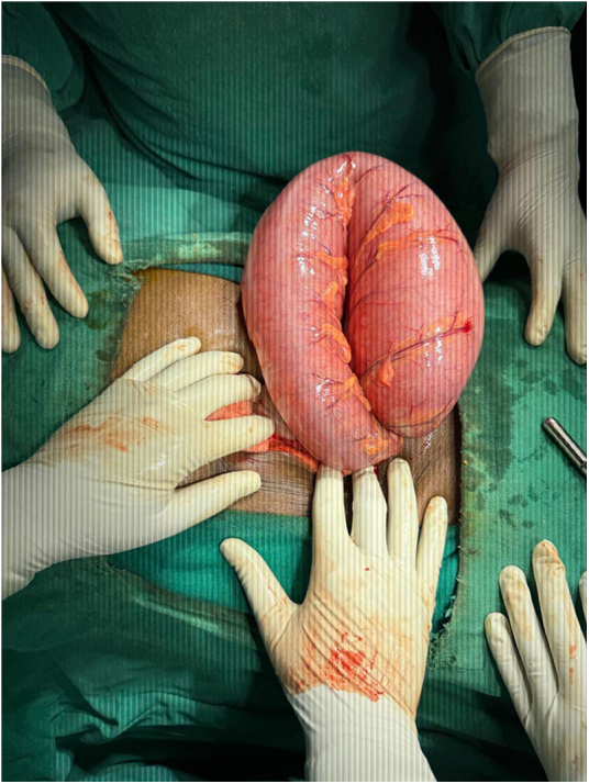 A case of situs inversus totalis with sigmoid volvulus: a case report of a rare coexistence.