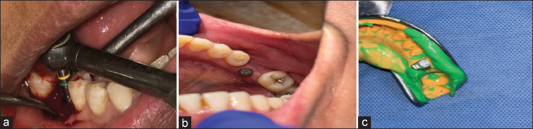 Comparison of bacterial colonization of implant abutment internal recess in internal hex and conical connection implants: An in vivo prospective study.