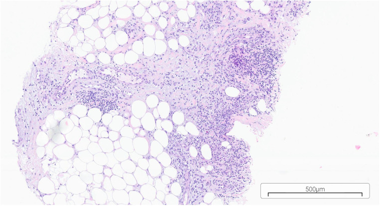 Aseptic Abscess Associated with Ankylosing Spondylitis-Cause or Effect of Therapy? Case Report.