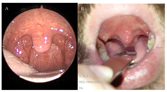 Uvulopalatopharyngoplasty Versus Expansion Sphincter Pharyngoplasty: A Single Centre Experience.
