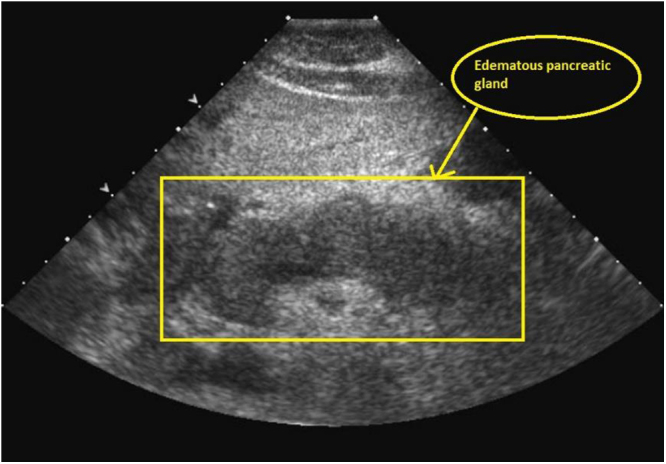 Hypertriglyceridemia induced acute pancreatitis in pregnancy: a case report.