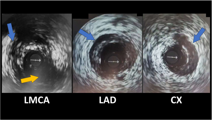 Spontaneous Coronary Artery Dissection Unveiled: Pathophysiology, Imaging, and Evolving Management Strategies.
