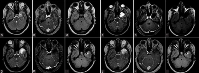 Polymorphous low-grade neuroepithelial tumor of the young.