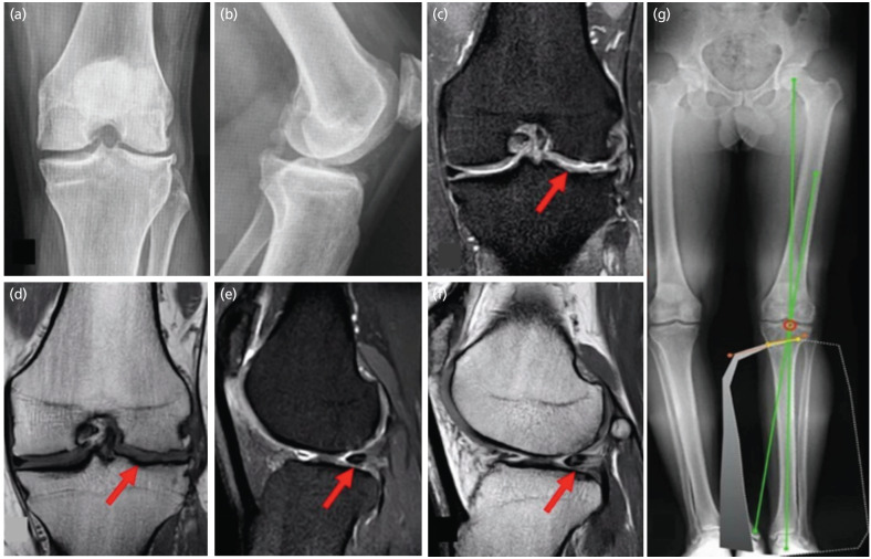 Strategic Integration of Surgical Techniques for Knee Preservation: A Case Report.