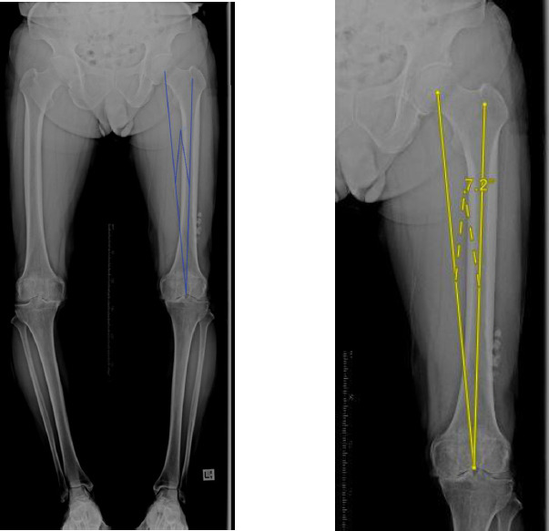 Navigation in total knee arthroplasty: a resident's friend or foe?
