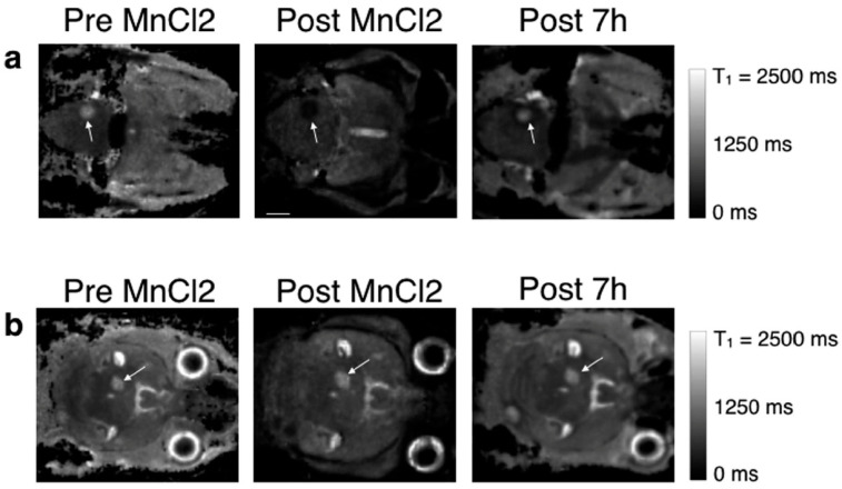 Manganese-Based Contrast Agents as Alternatives to Gadolinium: A Comprehensive Review.