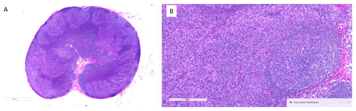 Dermatopathological Challenges in Objectively Characterizing Immunotherapy Response in Mycosis Fungoides.
