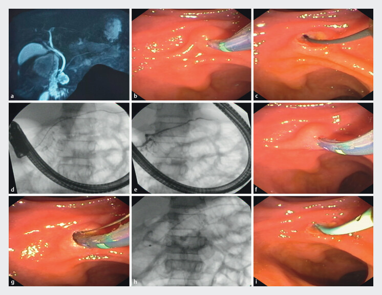 Prospective study on outcomes of endotherapy for pancreatic divisum in patients of recurrent acute pancreatitis.
