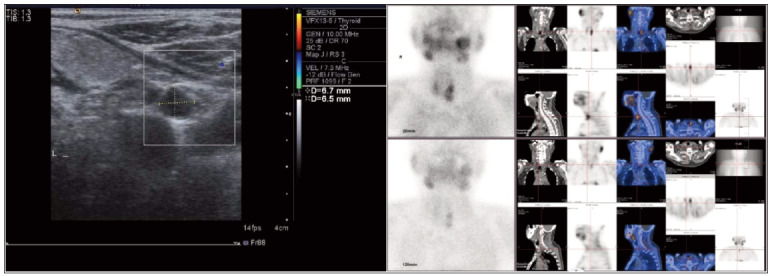 Clinical value of serum iPTH, ALP and serum markers levels in patients with secondary hyperparathyroidism receiving paricalcitol combined with cinacalcet.