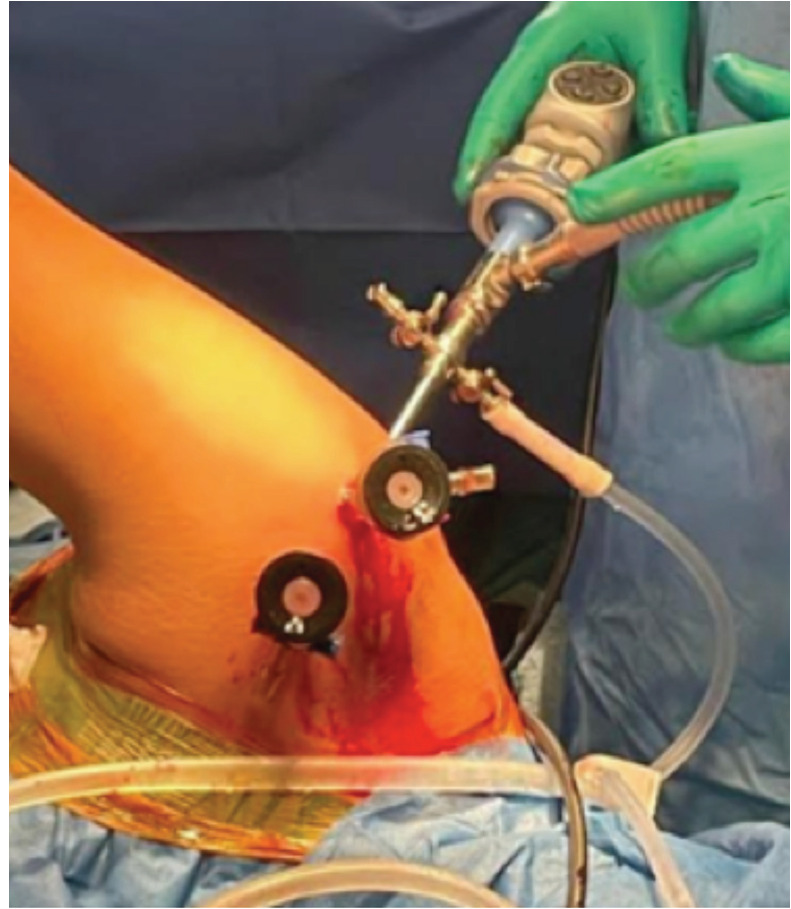 Clinical Outcome of Arthroscopic Bankart Repair and Remplissage in Recurrent Anterior Shoulder Dislocation in Manual Workers.
