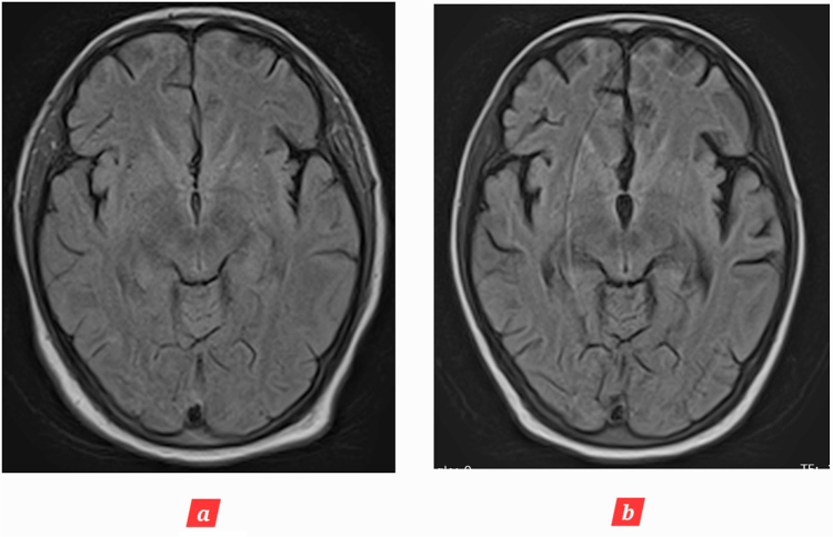 Age inconsistent brain atrophy following post cardiac arrest brain injury (PCABI): case report and review of literature.