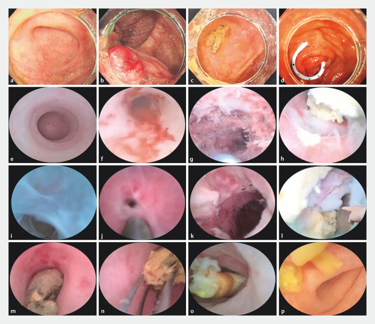 Diagnostic and therapeutic value of appendoscope-assisted endoscopic retrograde appendicitis therapy.