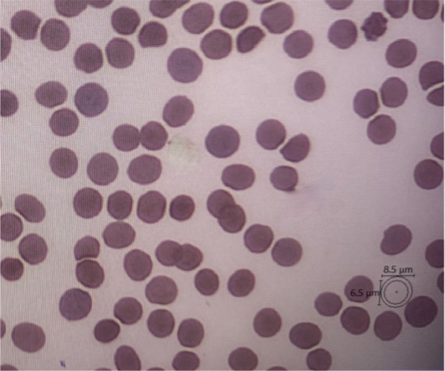 A Clever Stroke Mimic: Thrombotic Thrombocytopenic Purpura Without Schistocytes - A Case Report and Literature Review.