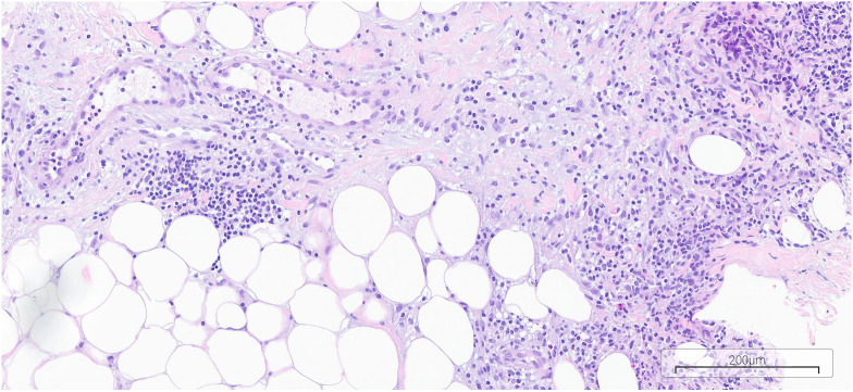 Aseptic Abscess Associated with Ankylosing Spondylitis-Cause or Effect of Therapy? Case Report.