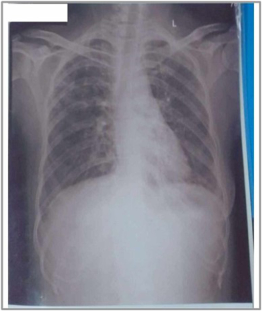 Undifferentiated inflammatory arthritis in a tuberculosis-positive patient: a diagnostic and therapeutic challenge - a case report.