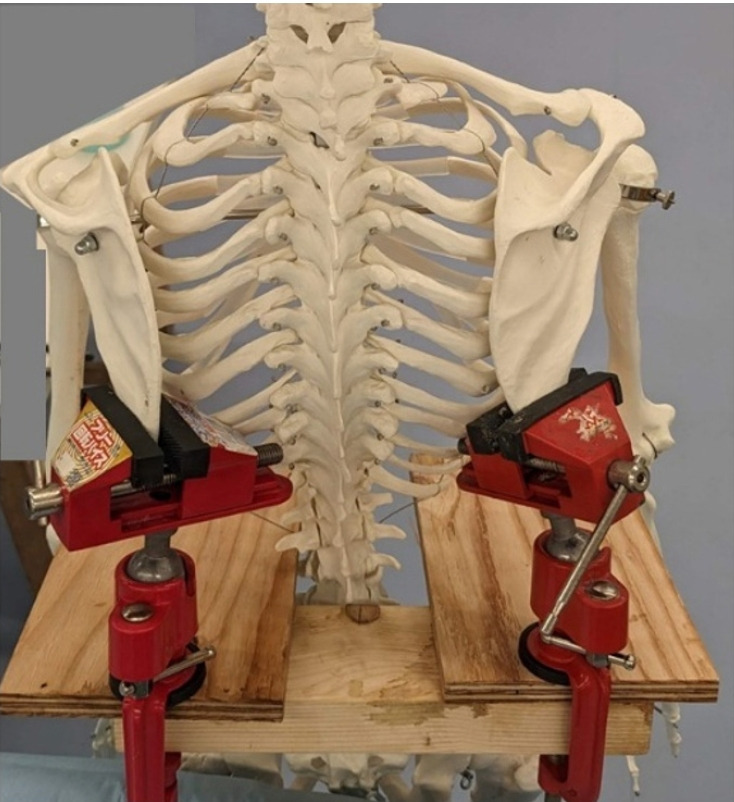 Effects of acromioclavicular and coracoclavicular ligament stability on acromioclavicular joint dislocation: insights from a cadaveric study.