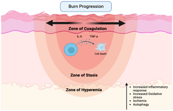 Pilot Study on Resuscitation Volume's Effect on Perfusion and Inflammatory Cytokine Expression in Peri-Burn Skin: Implications for Burn Conversion.