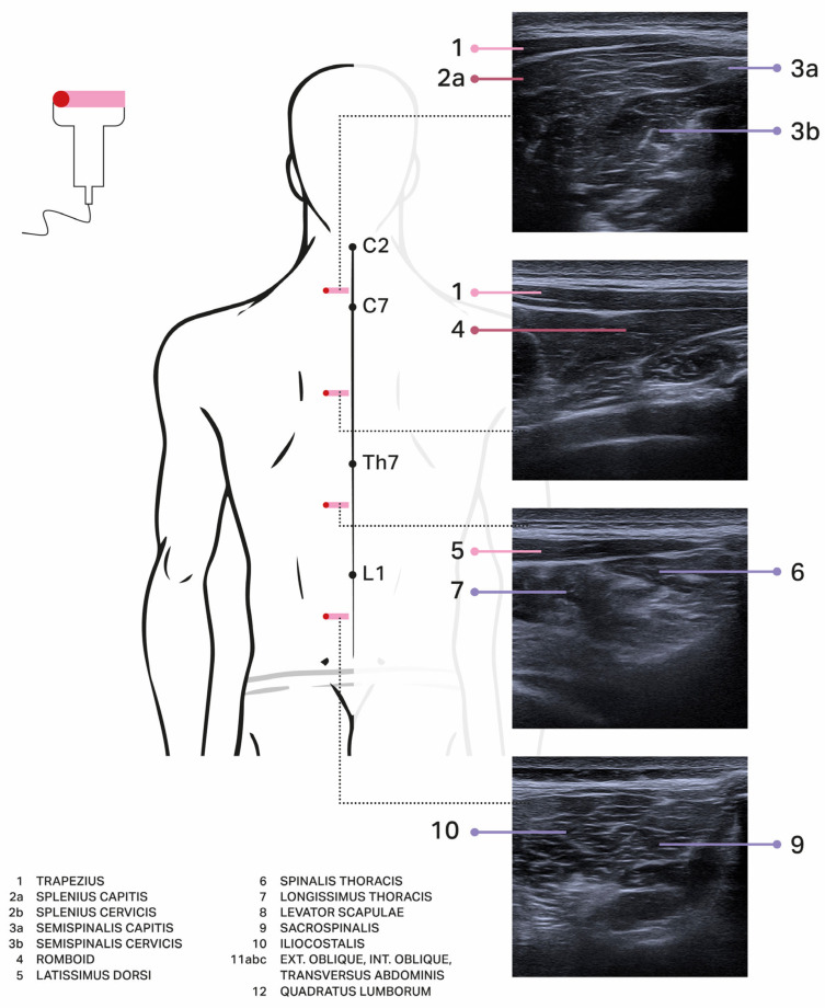 Case Series and Literature Review on Botulinum Toxin Efficacy in Axial Extensor Truncal Dystonia.