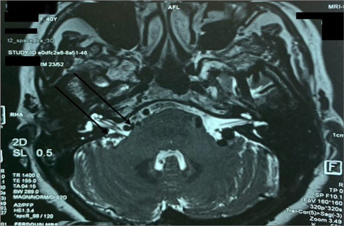 Dandy's vein decompression for trigeminal neuralgia: A rare venous conflict causing intractable facial pain.