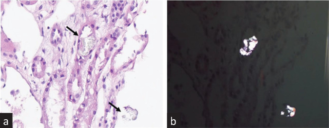 Dimethyl Oxalate Exposure Induced Oxalate Nephropathy: A Trigger for Acute Kidney Injury.