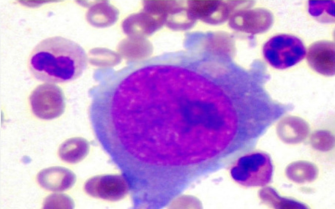 Parvovirus B19 Infection as a Cause of Refractory Anemia in Kidney Transplant Recipients: A Case Series.