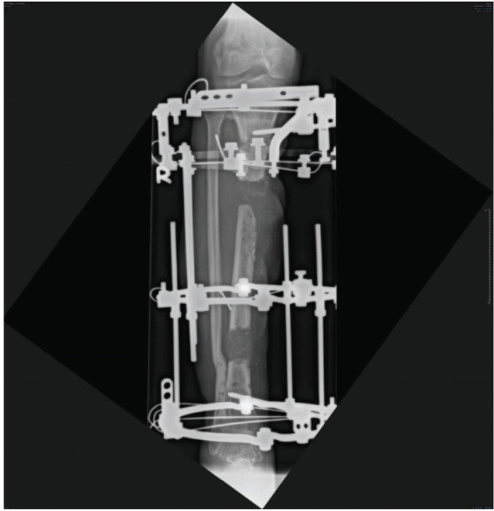 Clinical and Functional Outcomes of Ilizarov Bone Transport in Traumatic Tibial Bone Loss.