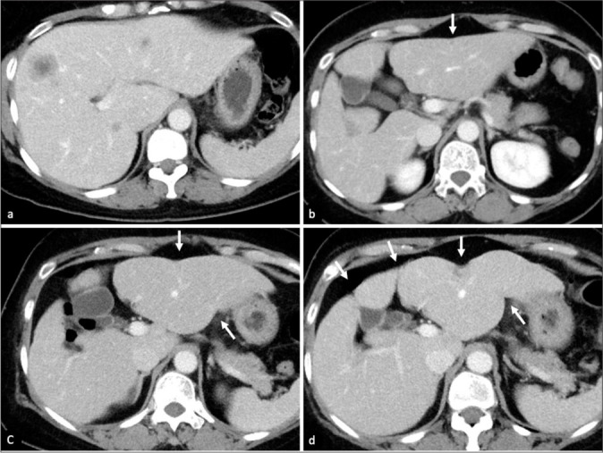 Imaging findings of post-chemotherapy non-metastatic hepatic parenchymal changes.