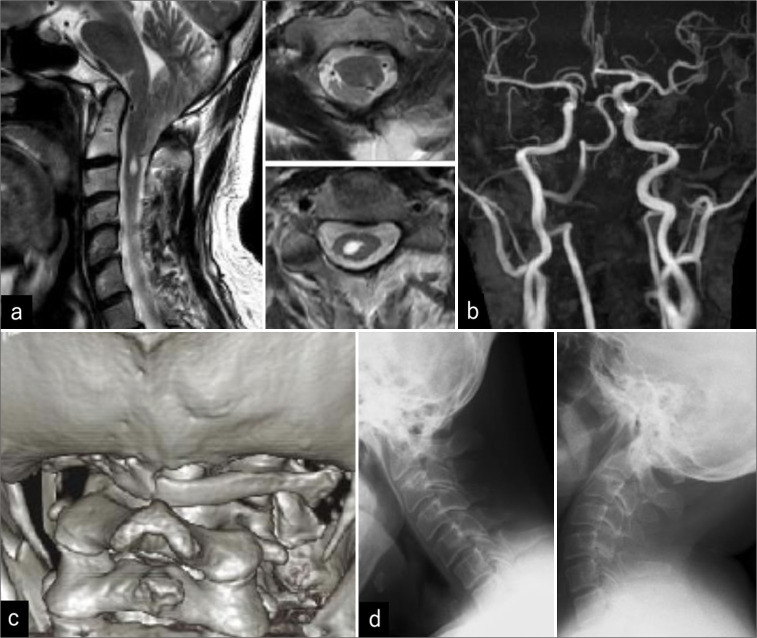 Cough syncope and central sleep apnea caused by CM1 with atlas assimilation in adult: An illustrative case.