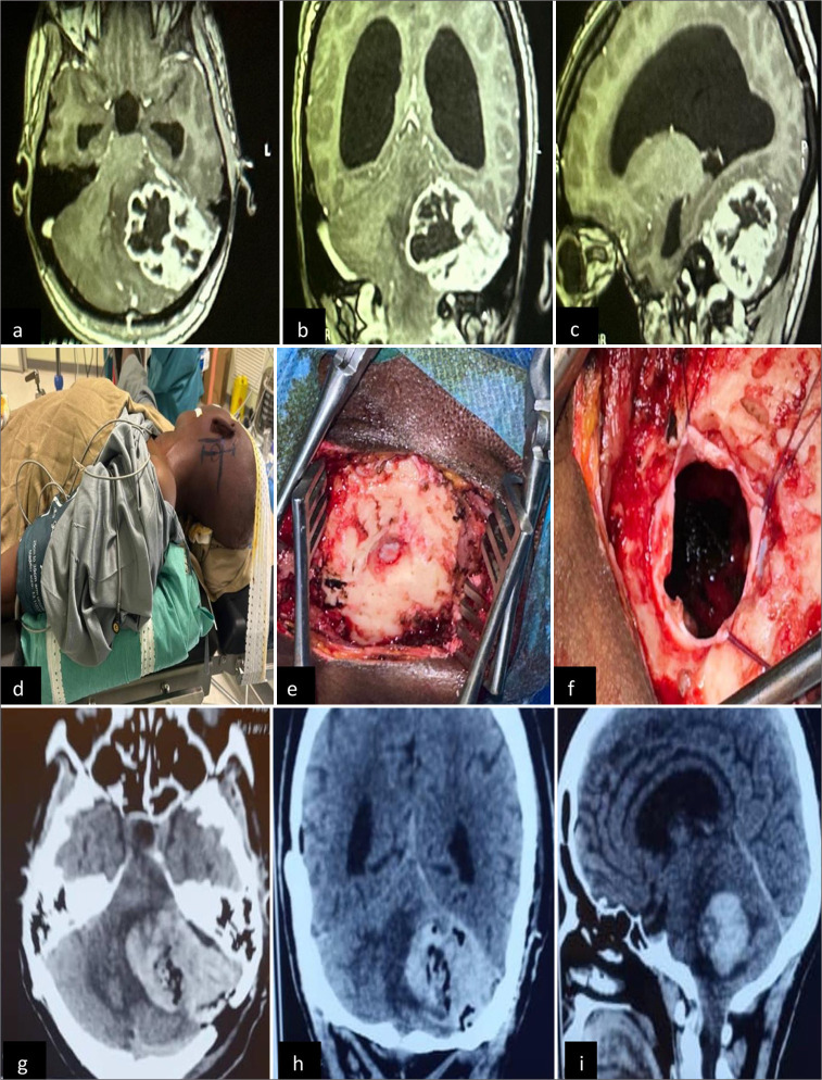 Complications of brain tumor surgery.