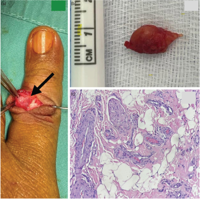 Hamartoma of the Finger: A Case Report.