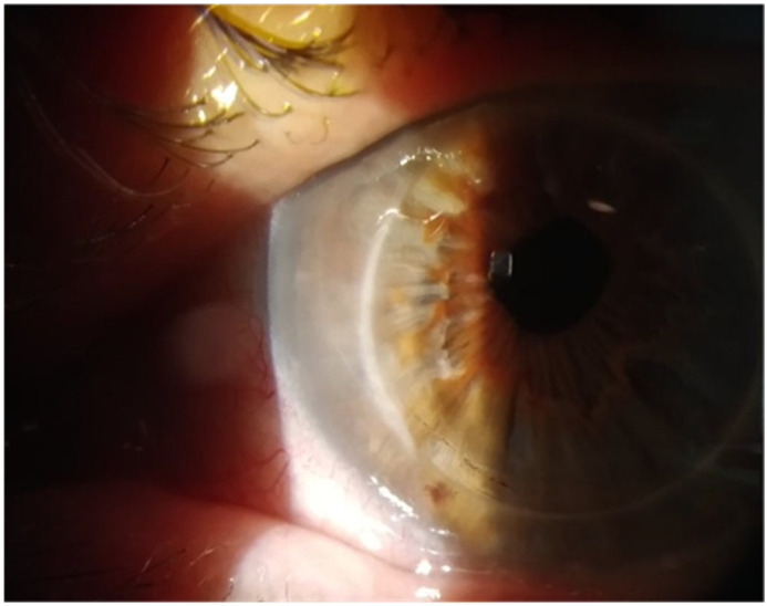 Case Series: Reactivation of Herpetic Keratitis After COVID-19 mRNA Vaccination During Herpetic Prophylaxis.