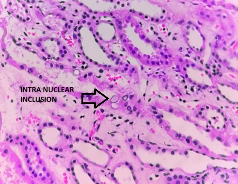 Disseminated Adenovirus Infection in Renal Transplant Recipients.