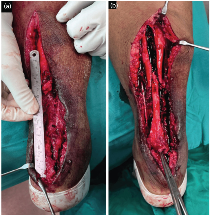 Experience in Managing a Complex Case of Infected Achilles Tendon Rupture with Segmental Loss: A Case Report.