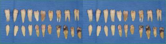 Experimental study on the compressive strength of fixed prosthetic restorations on tooth preparations with or without horizontal preparation.