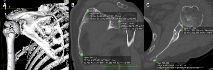 A comparative analysis of manual glenoid version measurement using two-dimensional and three-dimensional computed tomography imaging techniques.